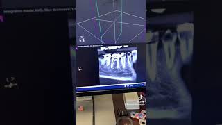 Root canal therapy of tooth #30.