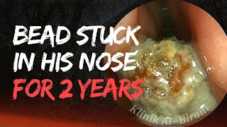 This Bead Stuck In His Nose For 2 years 😱‼️