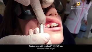 Gingivectomy with LiteTouch™ Er:YAG laser