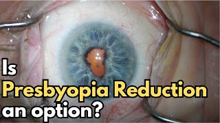 Cataract Surgery | Synechiolysis, Pupil Stretch, Malyugin Ring, AMD