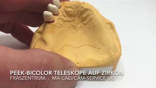 PEEK Teleskope auf Zirkon mit Rosa PEEK-Modellguss