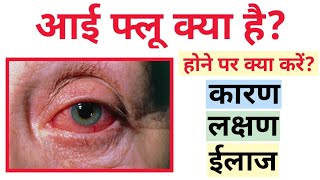 आई फ्लू क्या है❓आई फ्लू के लक्षण और उपचार || Eye flu (cause symptoms & Treatment)