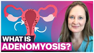 Adenomyosis EXPLAINED: Symptoms You Can't Ignore + Treatment Options