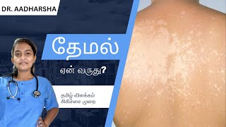 தேமல் என்றல் என்ன ? Explained | Why it occurs? How to treat? | நோயை பற்றி அறிவோம்