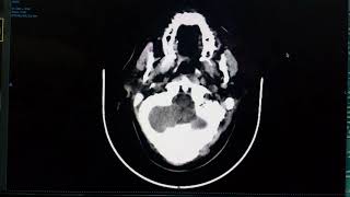 Obstructive Hydrocephalus on CT Scan