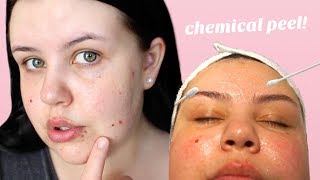 GETTING A CHEMICAL PEEL FOR MY ACNE SCARS | Vlog + Review