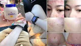 EFFECTIVE SA STRETCHMARKS, SCARS, ACNE AND INNER THIGH WHITENING || AR VITAMIN E CREAM REVIEW