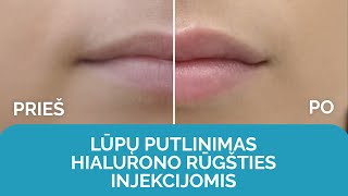 Lūpų putlinimas hialurono rūgšties injekcijomis | Nordclinic