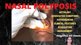 140.Nasal polyposis  #ethmoidal polyp - diagnosis and management  #nasalbreathing #polyp