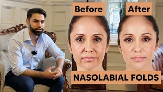 Can You Actually Get Rid of Smile Lines? (Nasolabial Folds)