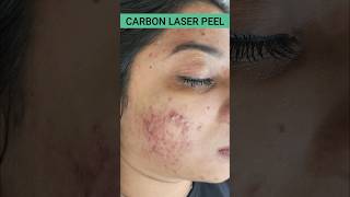 FASTEST ACNE RESULTS-CARBON LASER PEEL @DrArifMDDermatologist #ACNE #carbonpeel