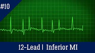 EKG/ECG Interpretation | Section 10: Acute Inferior MI