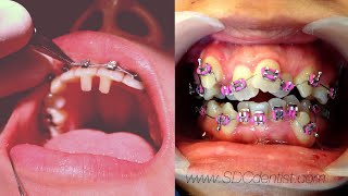 จัดฟัน แล้วฟันเคลื่อนแบบนี้ (Dental braces time lapse!)