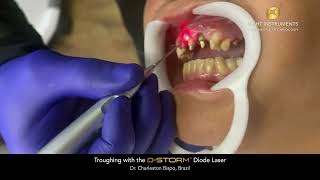 Troughing with the D-Storm™ Diode Laser