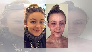 Woman stops using steroid cream for eczema and embraces natural inflamed skin