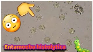 #Trophozoaite_of_Entamoeba_ histolytica# الاميبياء في البراز