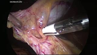 Steps of safe laparoscopic cholecystectomy explained in 5 minutes -unedited video.