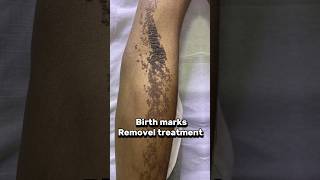 Birth marks removal- laser treatment #skincare #skincenter #birthmark #lasertreatment #kandy