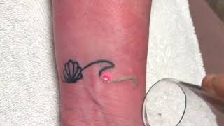 Wrist tattoo, removed with laser tattoo removal