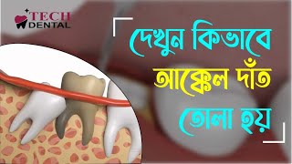 দেখুন কিভাবে আক্কেল দাঁত তোলা হয় ।। Tooth extraction Procedure ।। Tech Dental