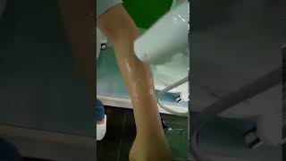 diode laser  sliding hair removal  treatment