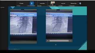 Lower common pathway of AVNRT   Dr  Lamyaa Allam