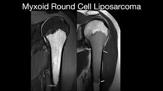 Myxoid Round Cell Liposarcoma