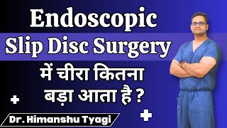 Endoscopic Slip Disc Surgery में चीरा कितना बड़ा आता है ? | Endoscopic Spine Surgery in Delhi NCR