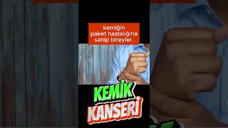 Kemik Kanseri Neden Olur? #shortsvideo