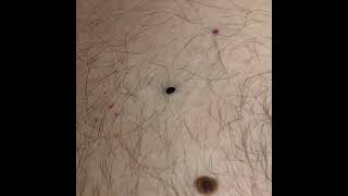 Blackheads Big