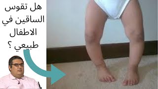 هل تقوس الساقين عند الاطفال والرضع طبيعي ؟ امتي يبقي مرضي ؟