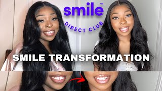 The Truth About Smile Direct Club | Treatment Plan & Review | My Experience