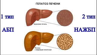 ЖИРОВАЯ болезнь ПЕЧЕНИ (ожирение). 2 типа: АЛКОГОЛЬНАЯ (АБП) и НЕАЛКОГОЛЬНАЯ (НАЖБП) / Фролов Ю.А.