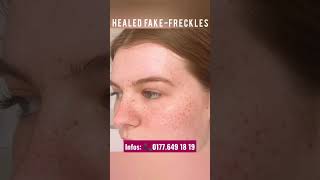 Healed Fake-Freckles | abgeheiltes Sommersprossen Permanent Make up