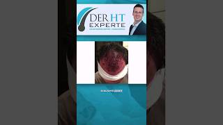 Reparatur einer katastrophalen Haartransplantation #derhtexperte