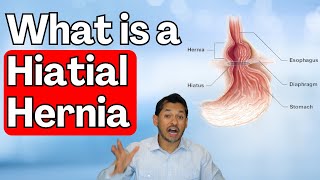 What is a Hiatal Hernia | Symptoms and Treatment