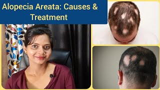 Alopecia Areata: Causes & Treatment. Baldness Treatment. Patchy Hair Loss. Ganjapan ka ilaaj.