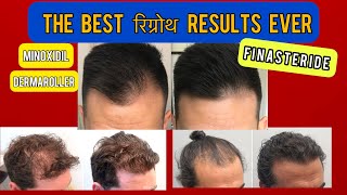 The BEST FINASTERIDE Results|DERMA ROLLER|MINOXIDIL|results|TRANSPLANT|Line|Hair|Fall|patch|Regrow