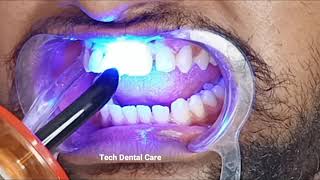 Teeth Gap Close, Diastema closer treatment time lapse