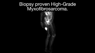 Biopsy Proven High Grade Myxofibrosarcoma