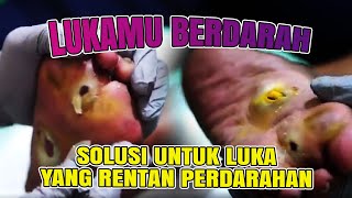 MENIPISKAN LUKA KAPALAN HARUS HATI-HATI❗AGAR TIDAK MENIMBULKAN PERDARAHAN