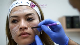 Cheek Biostimulator Injections