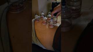 Cupping Therapy #relaxing #cuppingtherapy #muscle #youtubeshorts #viralvideo