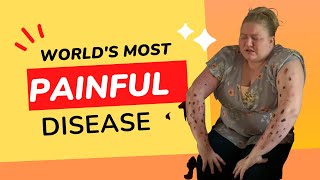 Most Painful Disease In The World #shorts