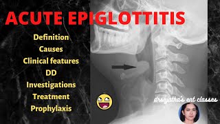 166.Acute Epiglottitis # treatment  of acute epiglottitis #stridor #epiglottis