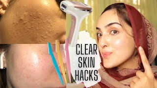 CLEAR SKIN HACKS I USE: Tinkle Razor, Laser, Dermarolling AT HOME  ~ Immy