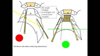 Interlocking Pelvic osteotomy in Dysplasia - J O"Hara, UK