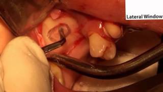 Lateral Window Sinus Lift