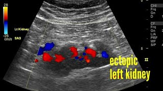 Ectopic kidney with malrotation, ultrasound and color, spectral Doppler video