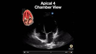 Normal Apical 4 Chamber View